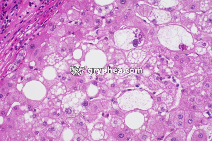 Foie pathologique x100 - gryphea.org